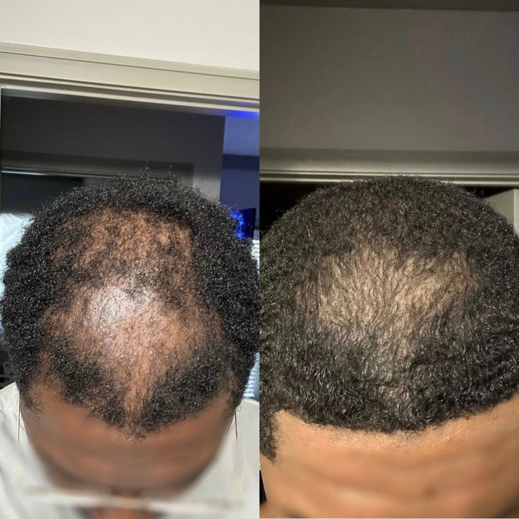 MONTH 0 MONTH 3
