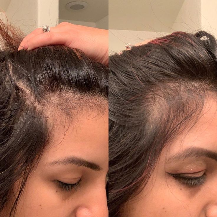 MONTH 0 MONTH 3